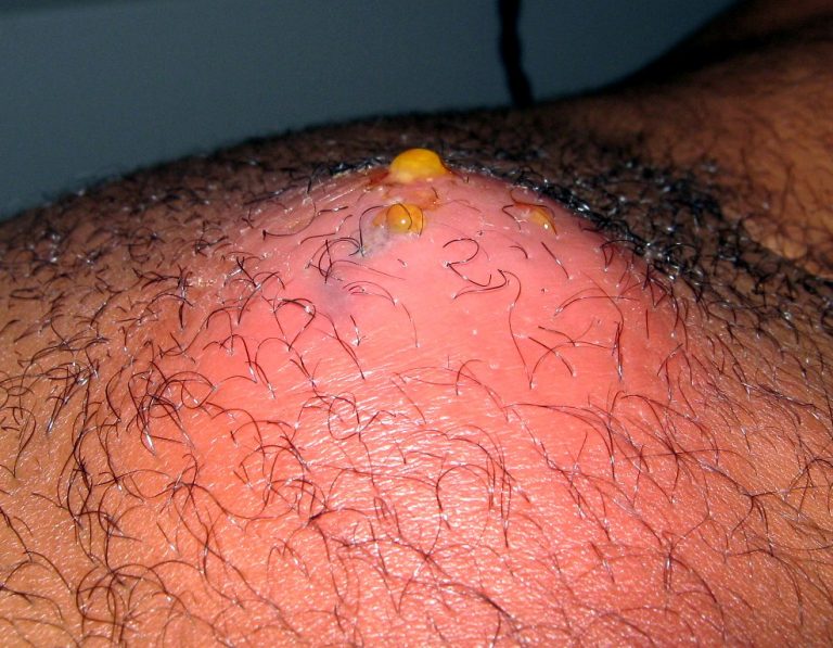 Abcès_sous_cutané_abdominal