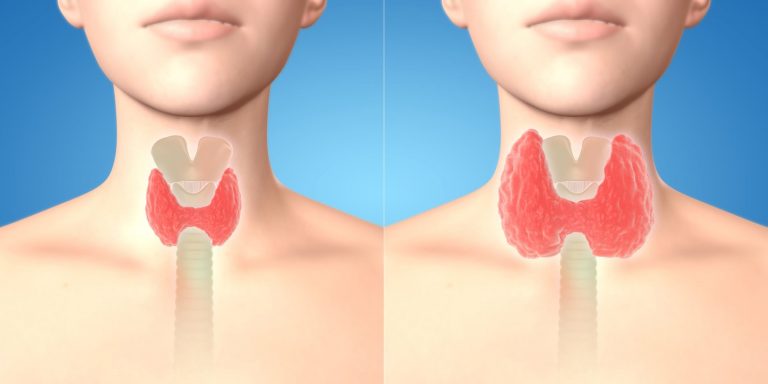 thyroide-bien-traiter-ses-troubles