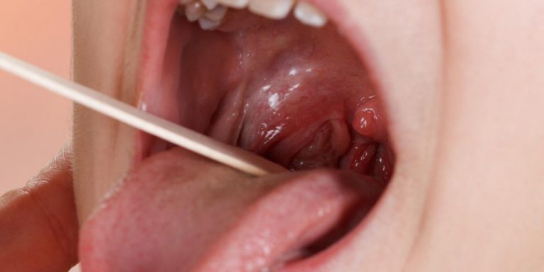 Image de l’article Amygdalite: une pathologie favorisée par certains milieux de vie.