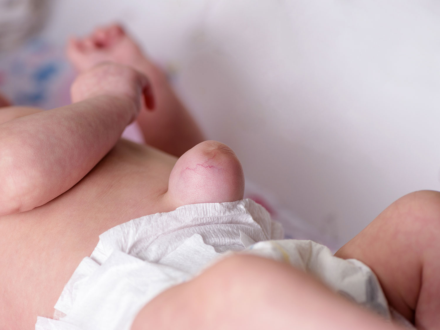 Hernie ombilicale : une pathologie fréquente chez les enfants