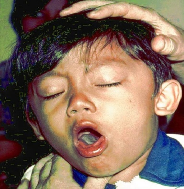 Toux-enfant-CDC-Wkimedia-Pertussis-1200×1236