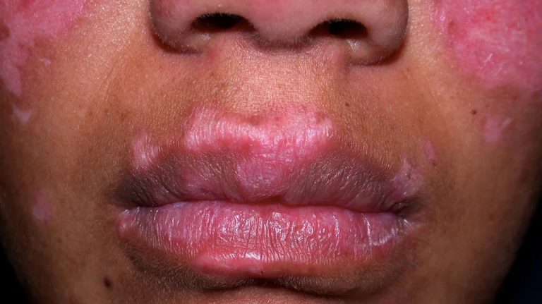 discoid-lupus-erythematosus-face-body1