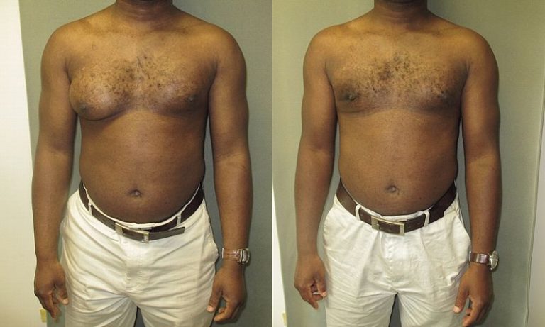 800px-Asymmetrical_gynecomastia