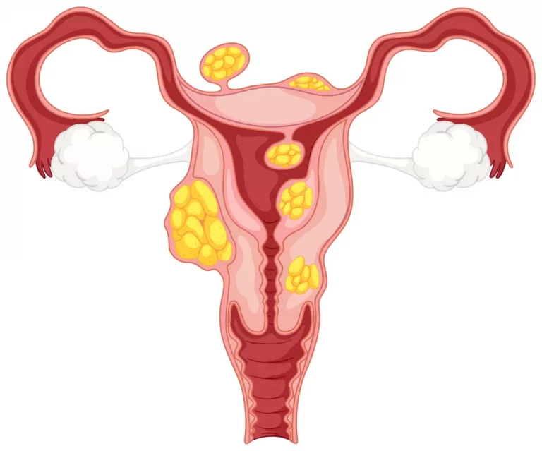 Image de l’article Fibrome utérin : types et symptômes