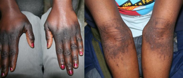 depigmentation