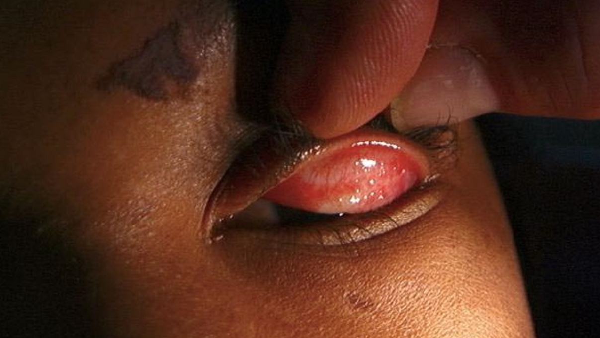 Lutte contre les maladies tropicales négligées (MTN) : le Bénin exempte de trachome selon l’OMS