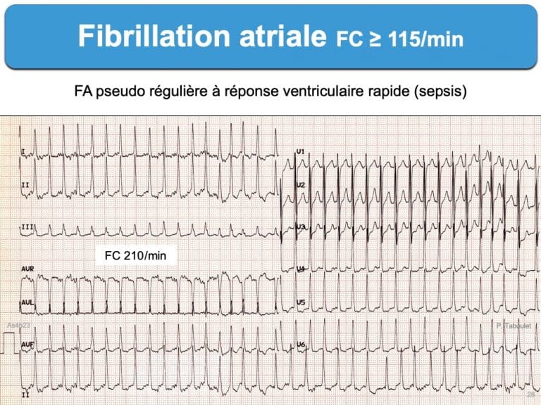 Fibrillation-atriale-rapide-ECG-Taboulet-1