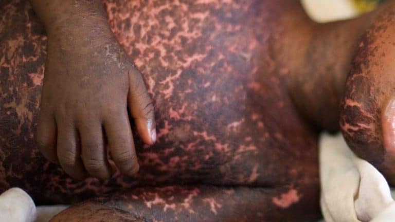 image-varicelle-afrique-1024×576
