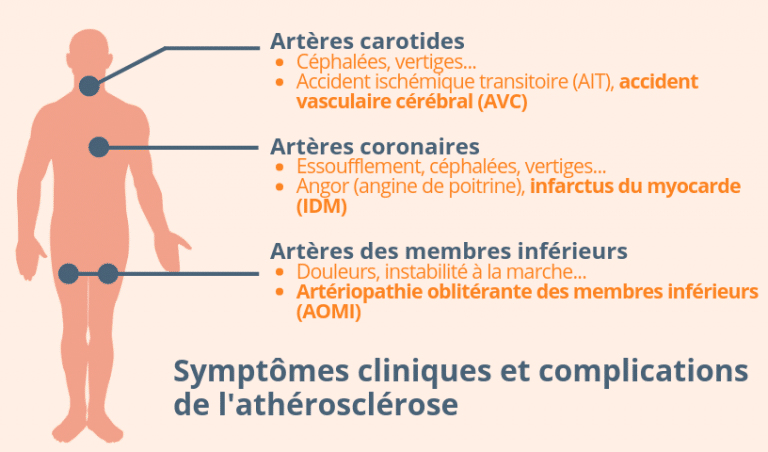 inserm-atherosclerosecomplications-plargeur