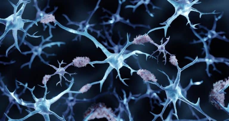 Alzheimer&rsquo;s,Disease,,Amyloid,Plaques,Aggregates,,3d,Illustration