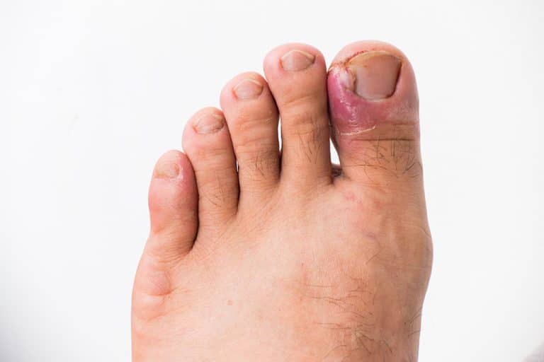 ongle-incarné-1024×683