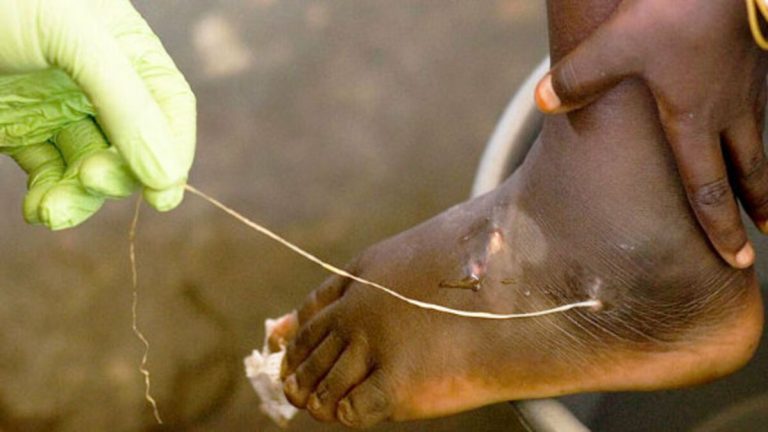 la-dracunculose-est-du-a-un-vers-parasite-nematode