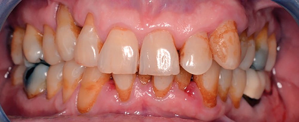 Journée Mondiale de la Santé Bucco-Dentaire 2024 : Attention aux Pics Dents, Ils Pourraient Aggraver Vos Problèmes Parodontaux !