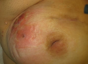 Mastite : Découvrez les Causes, Préventions et Solutions Efficaces !